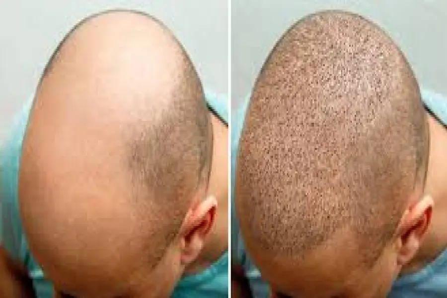 Hair Transplant in Turkey – Affordable & High Quality Procedures